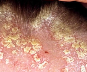 Saçta Kabuklu Kepek Saçta Kabuklu Kepek