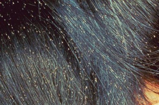 En İyi Kepek Şampuanı Kullanımı ve Faydaları Nelerdir?