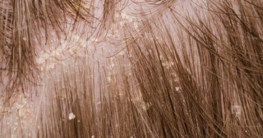 Kepek Hastalığı Belirtileri ve Tedavisi