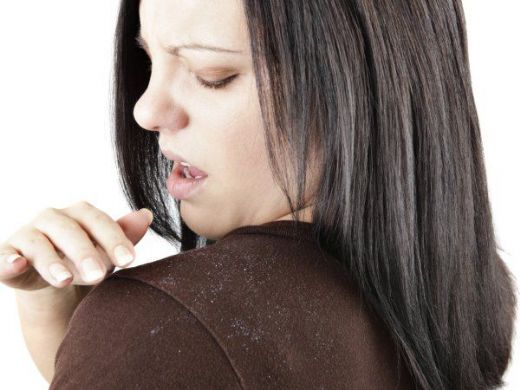 Elma Sirkesi Kepek İçin Kullanımı ve Faydaları Nelerdir?