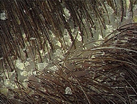 Kepek İlacı Kullanımı ve Faydaları Nelerdir?