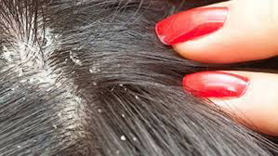 Kepek Nasıl Geçer?