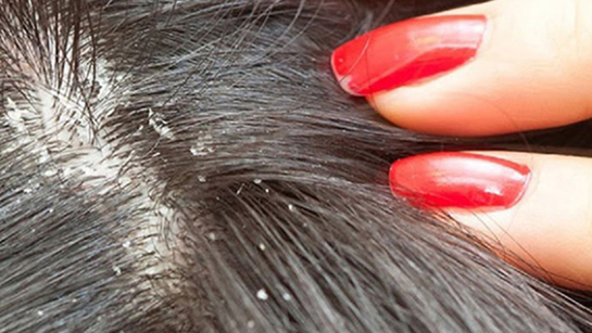 Kepek Saç Döker mi?