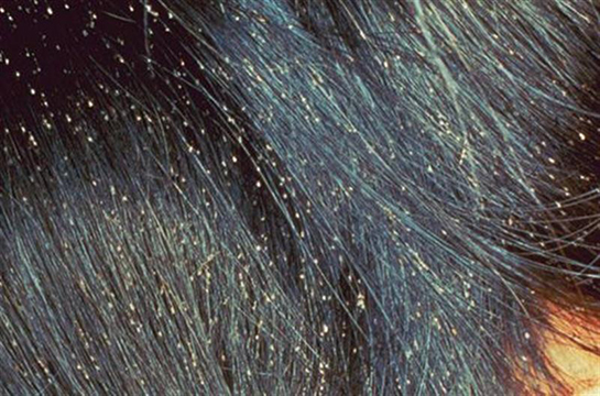 Saçta Kepek Neden Oluşur?